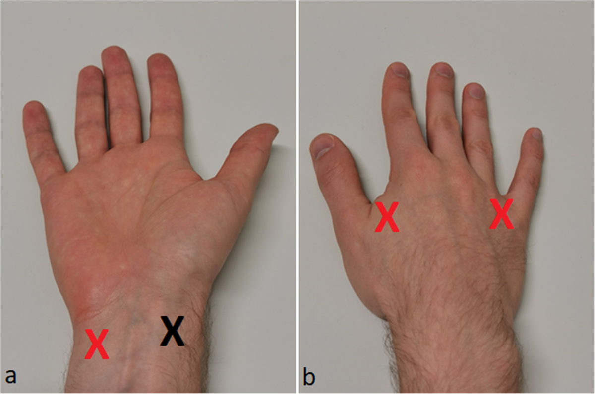 Contrast-enhanced ultrasound: a new tool for imaging the superficial  lymphatic vessels of the upper limb | European Radiology Experimental, image size:1200x796