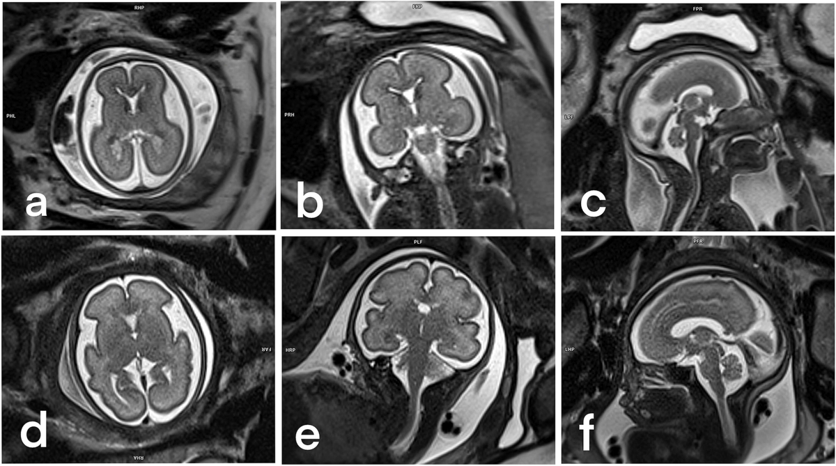 Fetal MRI: what's new? A short review | European Radiology Experimental | Full Text
