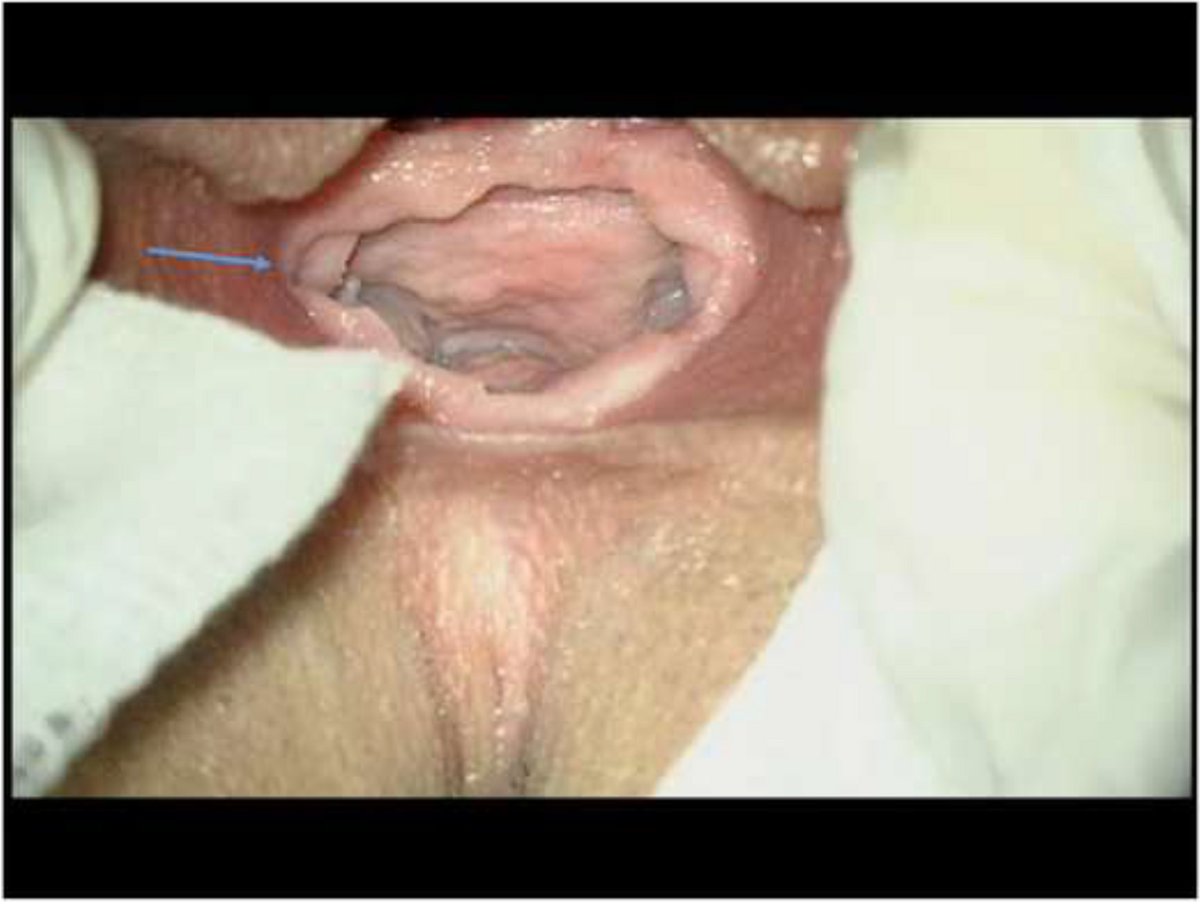 hymenal 