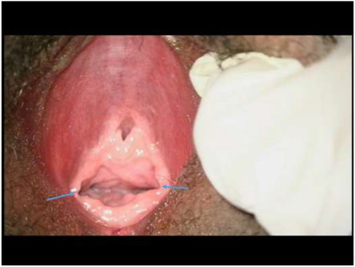 hymenal 