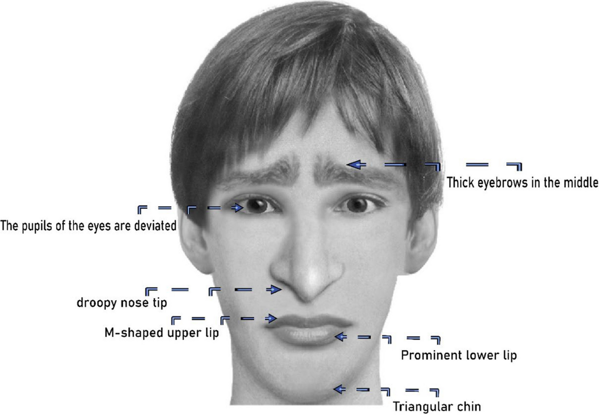 Mowat-Wilson syndrome: unraveling the complexities of diagnosis, treatment, and symptom management | Egyptian Journal of Medical Human Genetics | Springer Nature Link