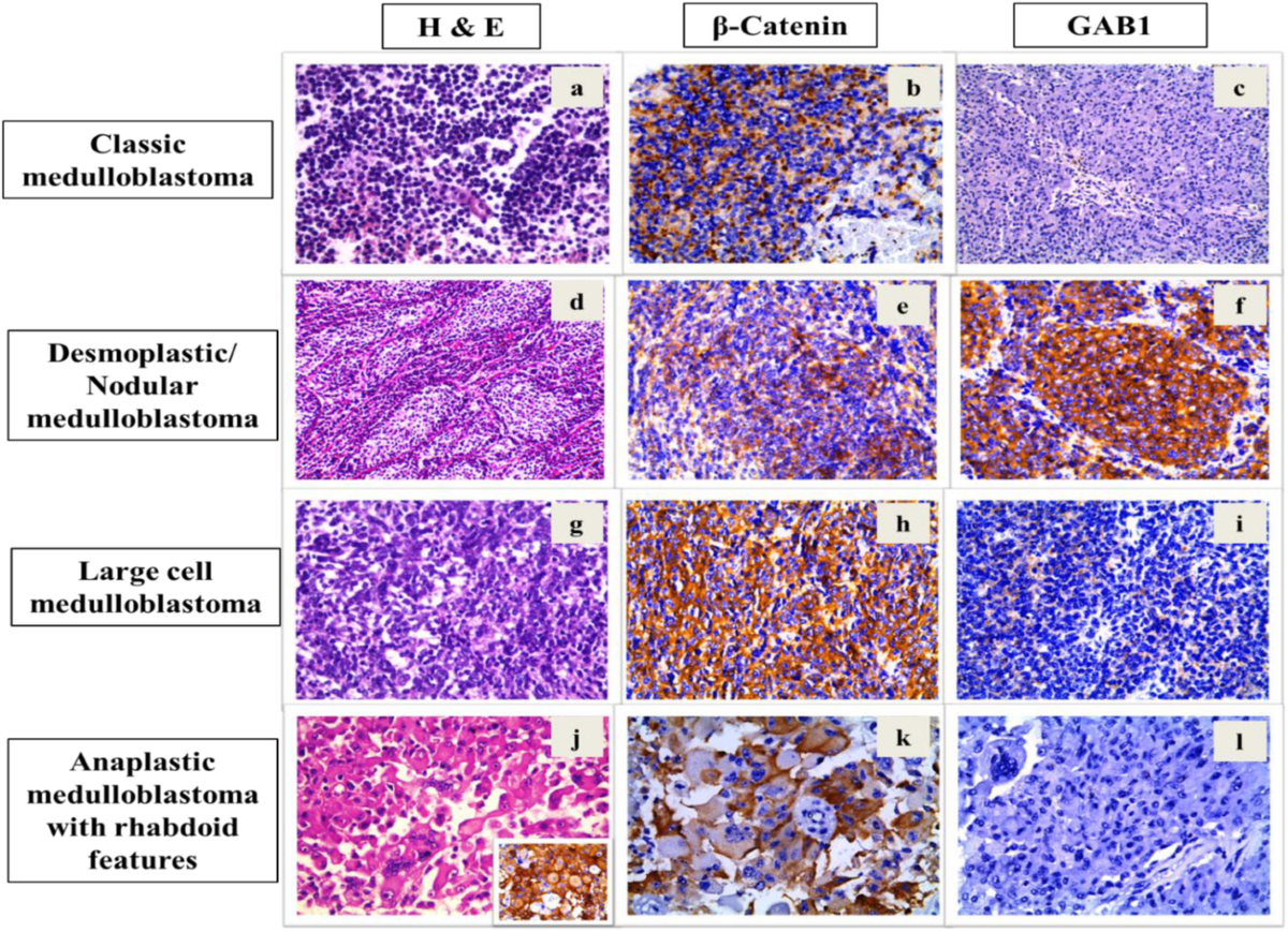 of medulloblastoma with melanotic and myogenic differentiation in childhood: new biological advances PDF) Myogenic and Melanotic Differentiated