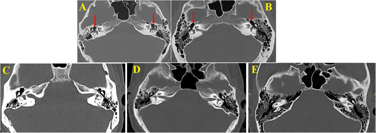 pyramidal eminence ct