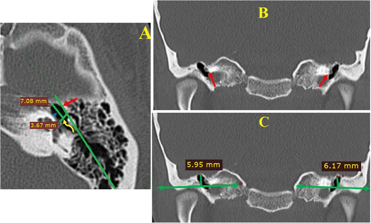 pyramidal eminence ct