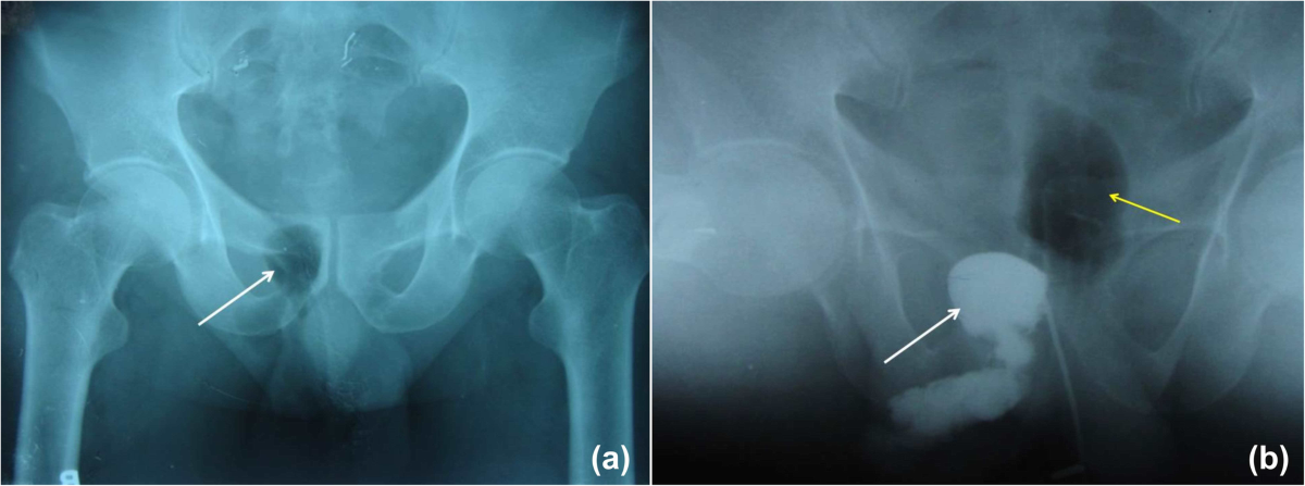 Current imaging techniques for evaluation of fistula in ano a  