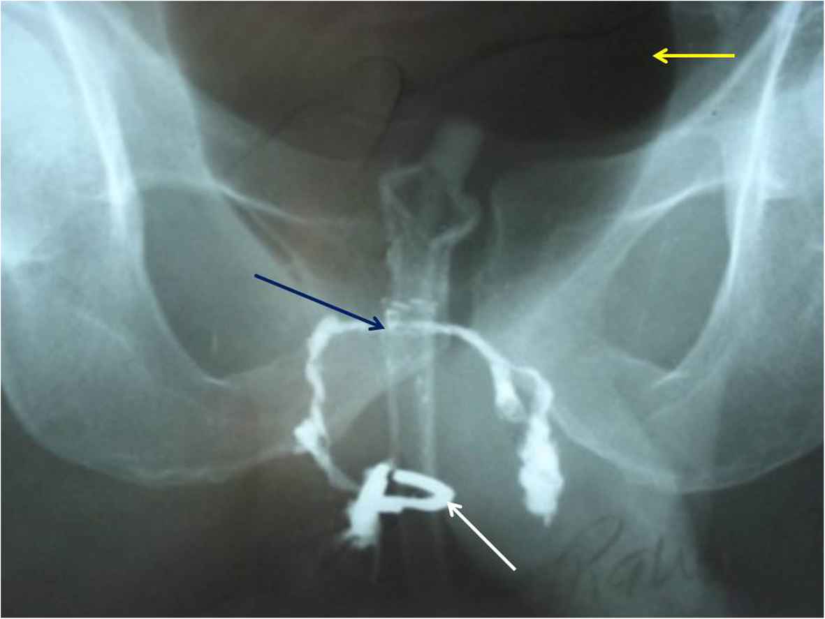Current imaging techniques for evaluation of fistula in ano a  