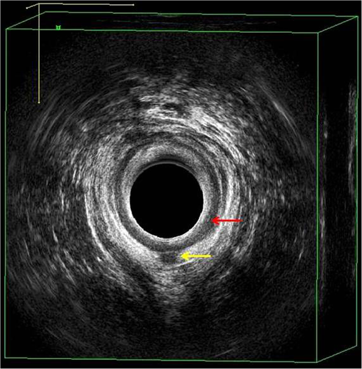 Current imaging techniques for evaluation of fistula in ano a review  