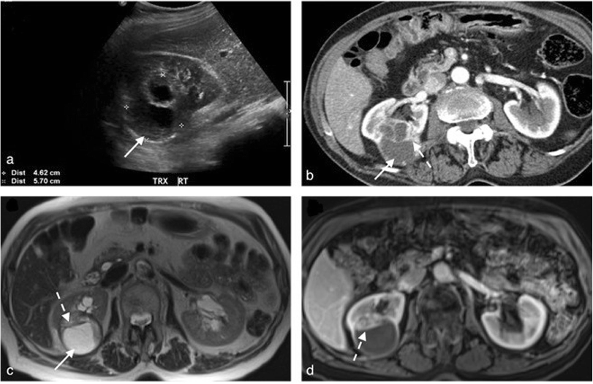 multimodality-imaging-review-of-focal-renal-lesions-egyptian-journal-of-radiology-and-nuclear-medicine-full-text