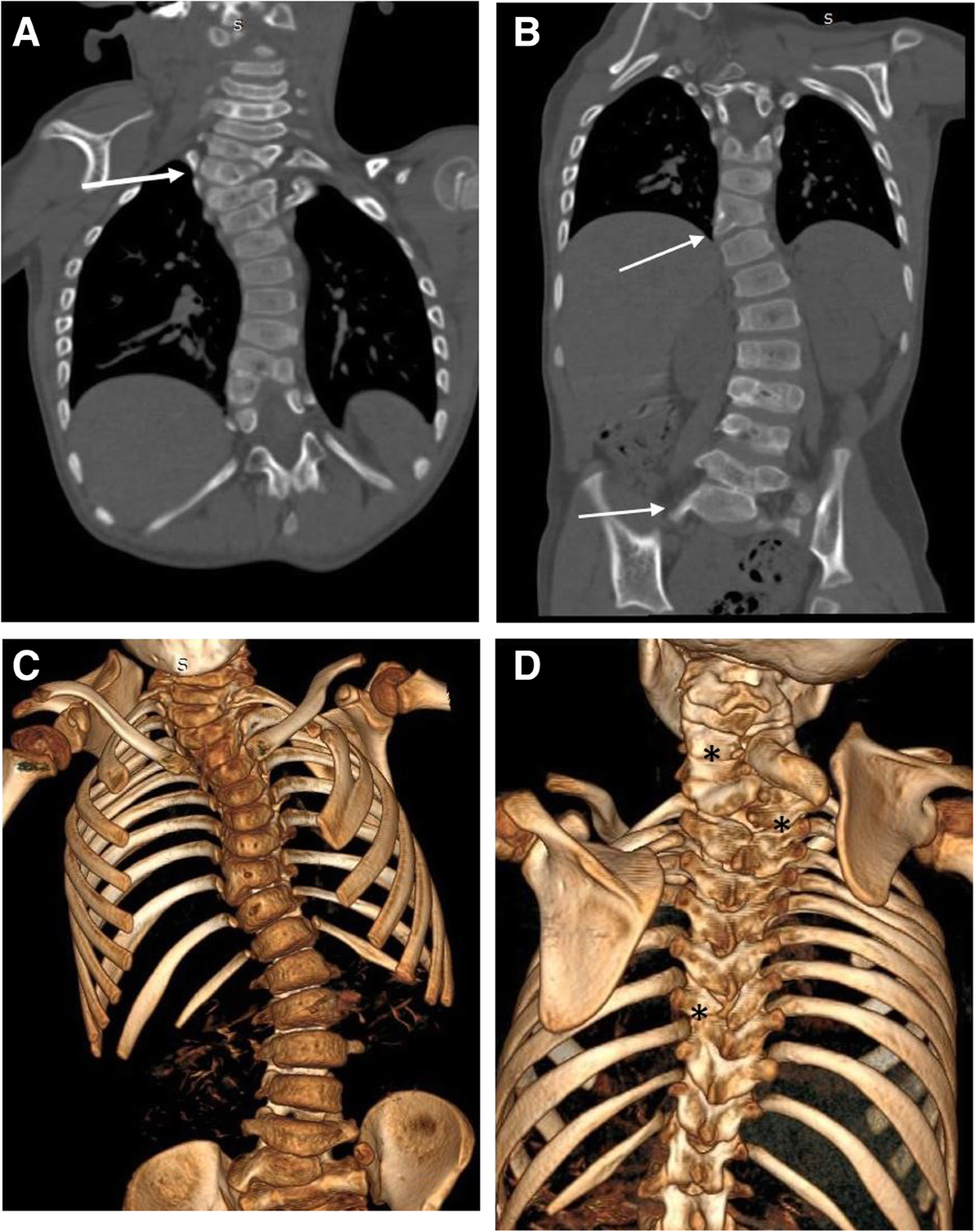 Klippel-Feil syndrome with multiple skeletal anomalies, Dandy-Walker  spectrum, and occipital cephalocele—a rare presentation | Egyptian Journal  of Radiology and Nuclear Medicine, image size:1200x1515