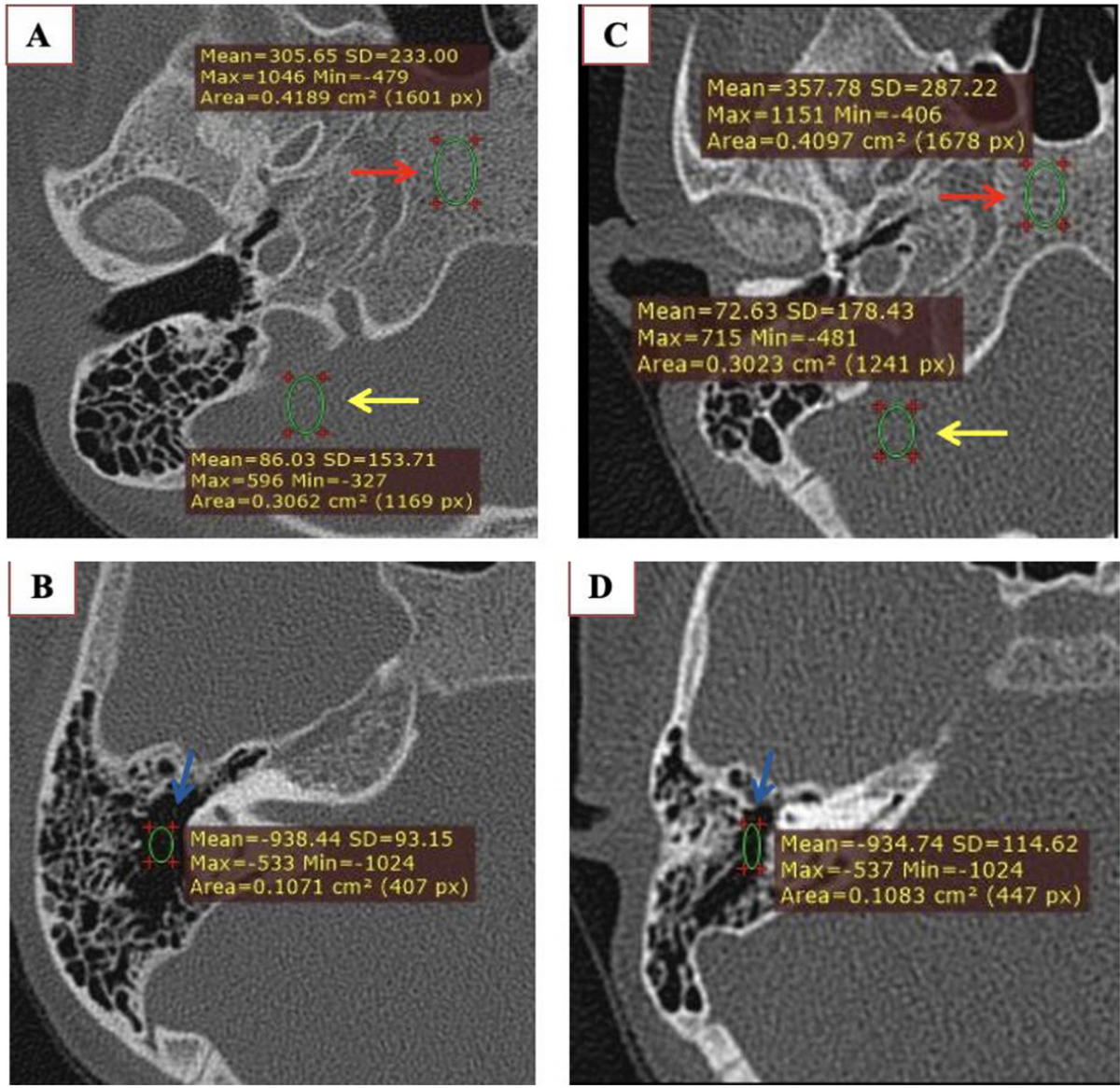pyramidal eminence ct