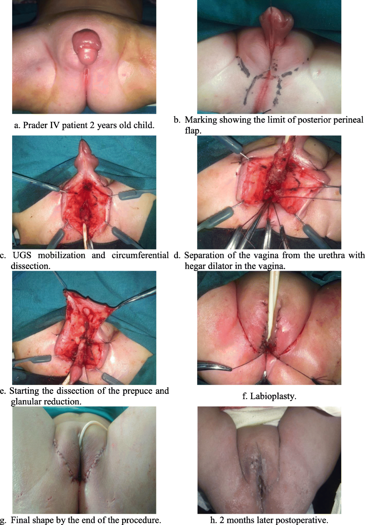  Genital modification 