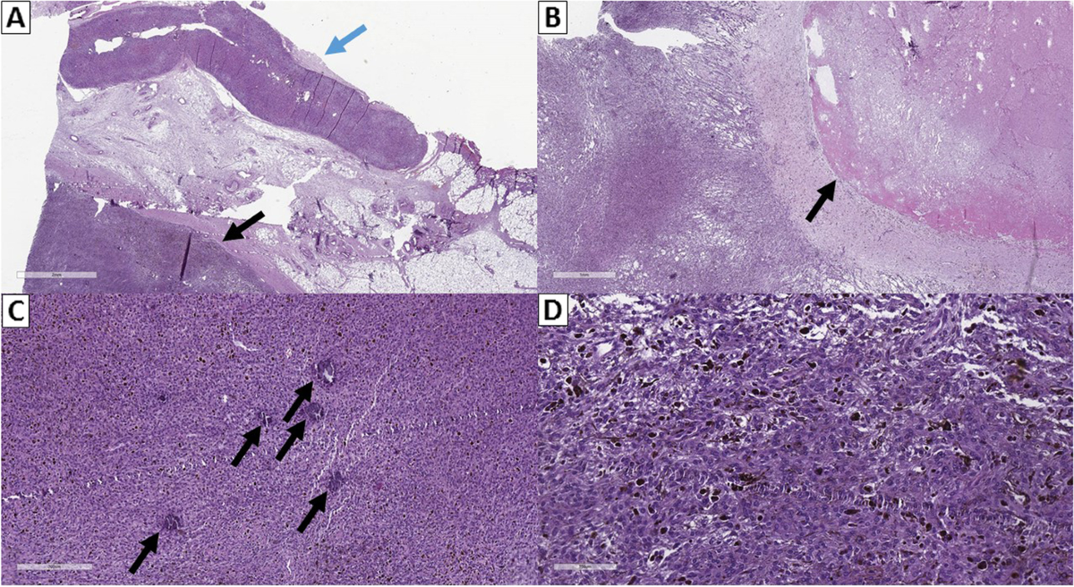 melanotic schwannoma pathology Pathology Outlines