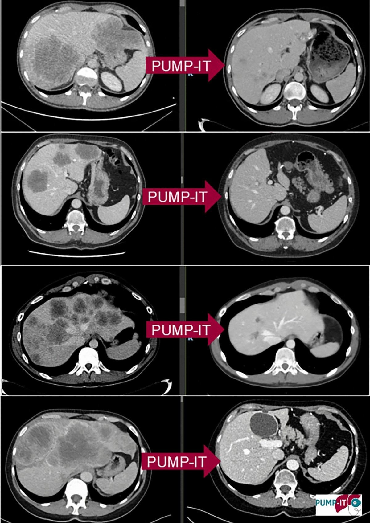 The Landmark Series: Hepatic Arterial Infusion Pump Chemotherapy for  Colorectal Liver Metastases and Intrahepatic Cholangiocarcinoma | Annals of  Surgical Oncology