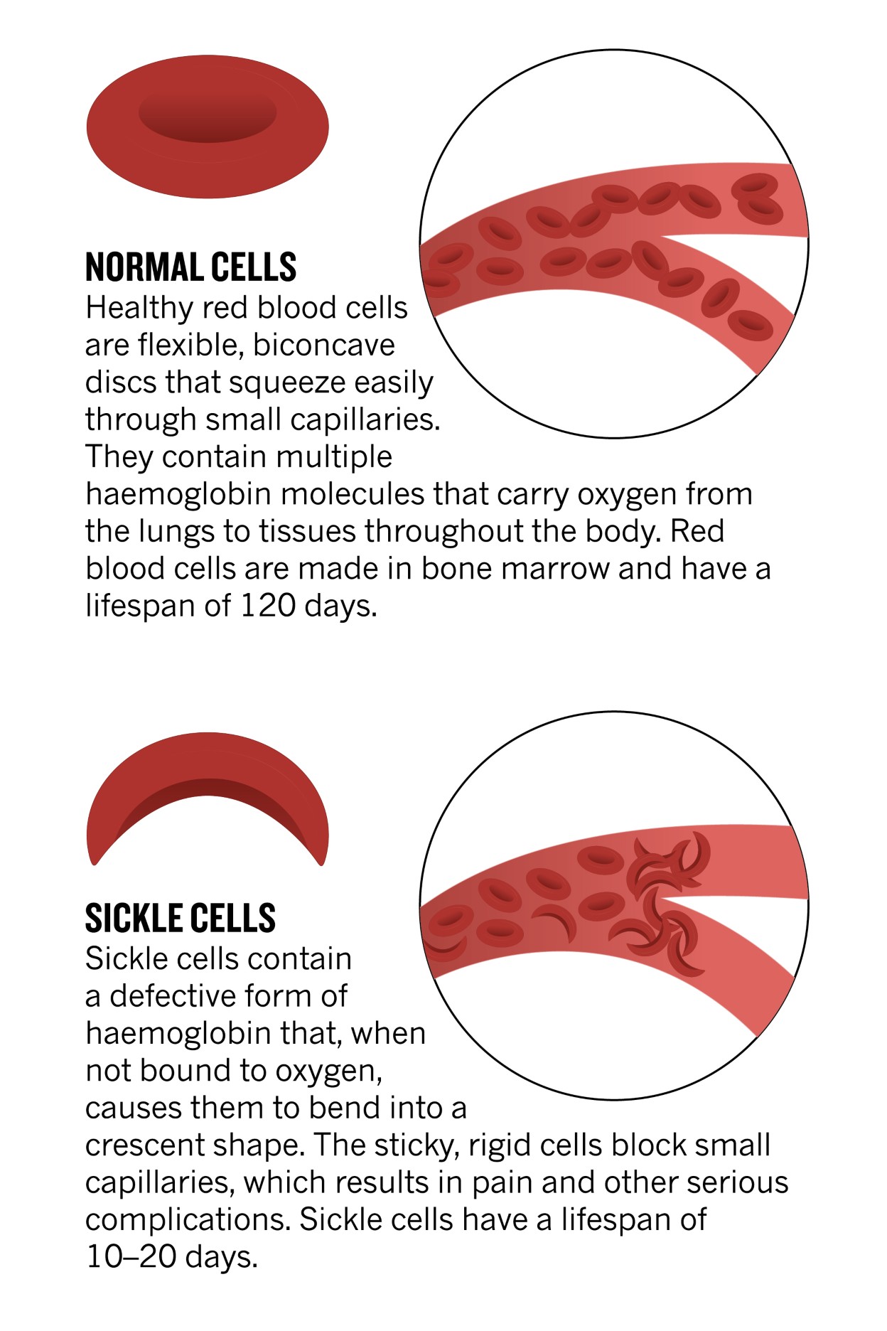 Hemoglobin Mutations Cause Sickle Cell Disease