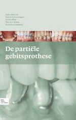 1 Partiële gebitsprothese; functies en typen