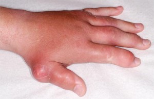 Gicht | Hyperurikämie | Uratkristallarthropathie