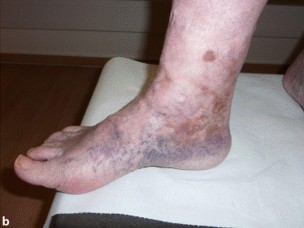 Venenthrombosen Tiefe Beinvenenthrombose Mesenterialvenenthrombose Pfortaderthrombose Springermedizin De