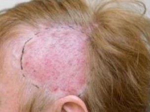 Tumoren Von Haut Und Schleimhauten Tumoren Von Haut Und Schleimhauten Springermedizin De