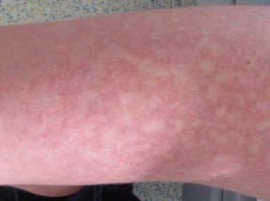 infektiologie infektiologie springermedizin de