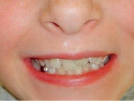 Antarctica persoon trompet Tandheelkunde | Kindvriendelijke kroon op de carieuze melkmolaar | mijn-bsl