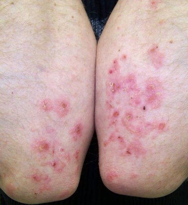Dermatitis herpetiformis | Dermatitis herpetiformis und sonstige Formen der  Weizensensitivitt | springermedizin.de
