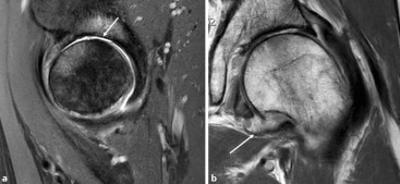 Magnetresonanztomografie | Entzndliche Vernderungen des Hftgelenks |  springermedizin.de