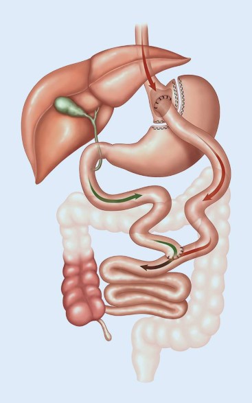 Medizinische Probleme nach Magenbypass