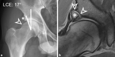 Hftdysplasie | Properative MRT-Bildgebung bei Hftdysplasie |  springermedizin.de