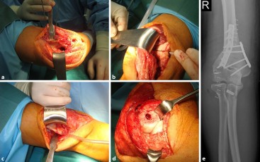 Revista Brasileira de Ortopedia - Treatment of Distal Radio Vicious  Consolidation: Corrective Osteotomy Through 3D Printing  Prototyping<sup>*</sup>