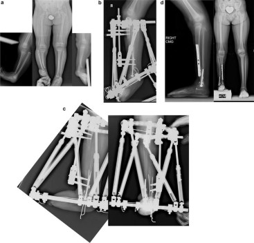 An unusual form of congenital anterolateral tibial angulation—the delta  tibia