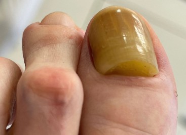 Erkrankungen der Nägel | Warum ist ihr Nagel so gelb und verdickt? |  springermedizin.de
