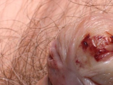 Rote punkte an eichel