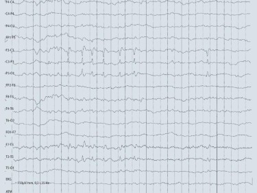 Epilepsie Bei Kindern Und Jugendlichen Springermedizin De
