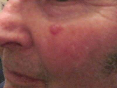 Kugeliger Tumor wächst ziemlich schnell