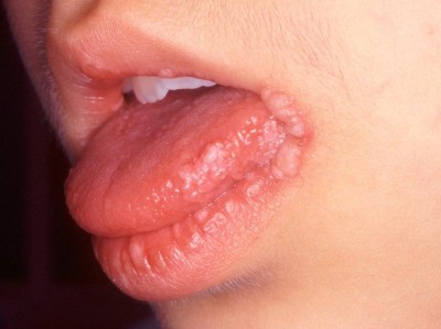 Hautveränderungen an Lippen und Zunge
