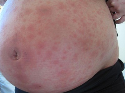 Schwanger und auf einmal juckt der Bauch!