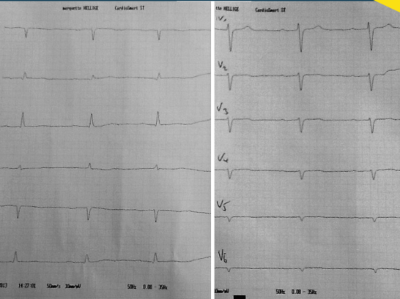 „Komisches“ EKG bei Thoraxschmerz