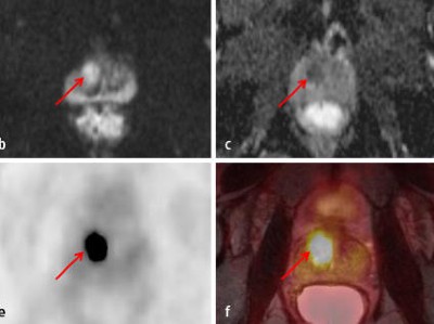 Ga-PSMA-PET MRT Verdacht auf Prostatakarzinom