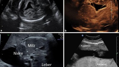 Fetale CMV-Infektion