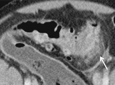 Akute Sigmadivertikulitis