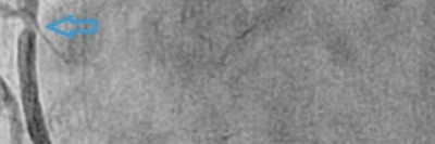 Koronarangiographie mit "wandernden" Stenosen