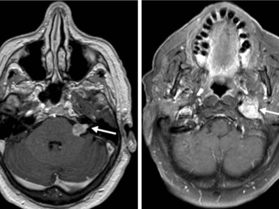 Tumor im linken Kleinhirnbrückenwinkel und inneren Gehörgang (linkes Bild) und Tumor am Foramen jugulare (rechtes Bild)