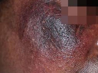 Exogene Ochronose im Gesicht einer 56-jährigen Patientin