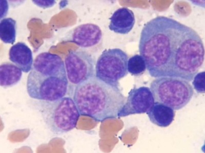Multiples Myelom