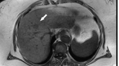 Hepatozelluläres Karzinom im Lebersegment VIII
