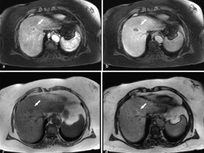 Hepatozelluläres Karzinom im Lebersegment VIII