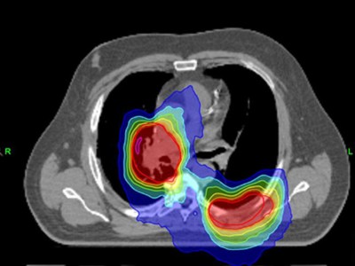 Bestrahlung eines Lungenkarzinoms