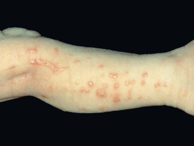 Incontinentia pigmenti