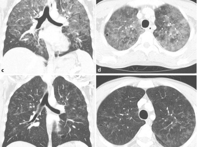 Pneumocystis-jirovecii-Pneumonie in der CT