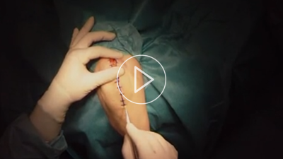 Endoprothetischer Ersatz des Ellenbogengelenks bei RA